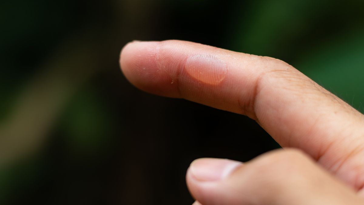 Pourquoi ne pas percer une cloque de brûlure ?